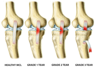Classificação lesão ligamento colateral lateral.