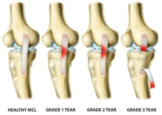 ligamento colateral lateral