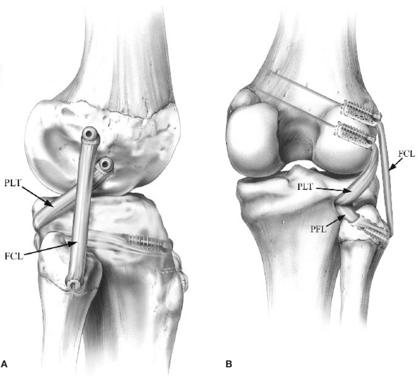 Tratamento cirúrgico do ligamento  colateral lateral.