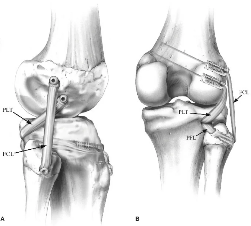 ligamento colateral lateral