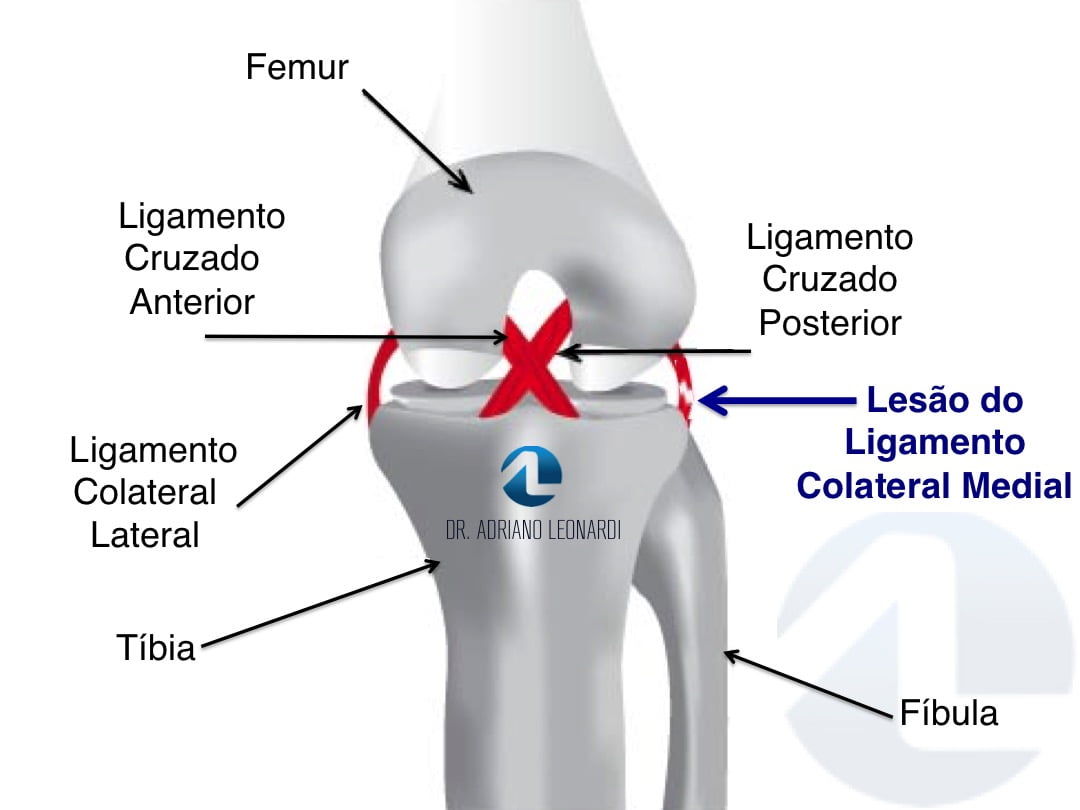 Ligamento medial sintomas colateral rompimento