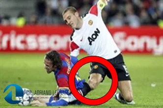 Causas da lesão do ligamento colateral medial.