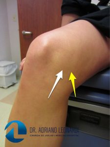 inchaço no joelho causado por lesão do ligamento colateral medial
