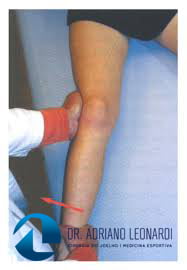 Ortopedista diagnosticando lesão do ligamento colateral medial