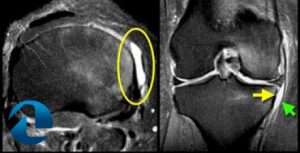 radiografia do joelho para identificar lesão do ligamento colateral medial