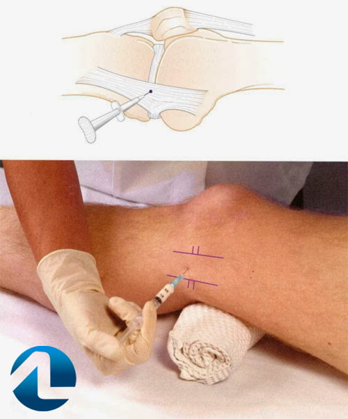Tratamento não cirúrgico da lesão do ligamento colateral medial.