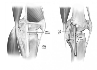 Anatomia ligamento colateral medial.