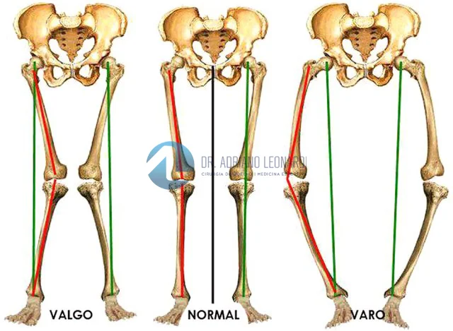 Ilustração de lesões iliotibial.