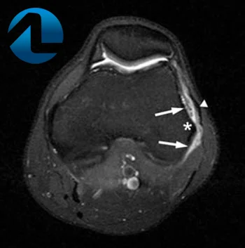 Exame de imagem síndrome iliotibial.