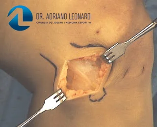 Cirúrgia da banda iliotibial.