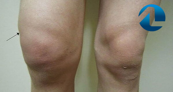 semne de luxatie in articulatia genunchiului inflamația articulațiilor mari și volatilitatea durerii observată