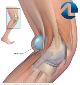 artroza încheieturii modul de tratament rătăcind dureri articulare severe
