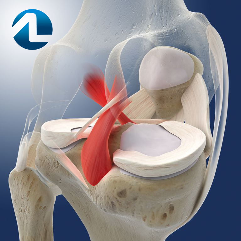 Ilustração de lesão no ligamento cruzado posterior.