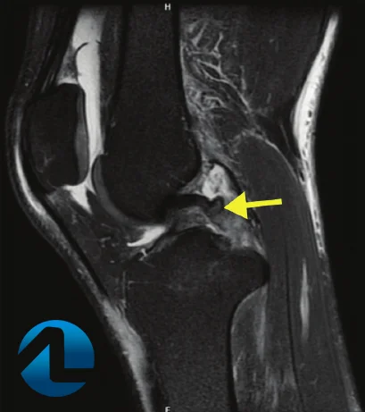Ressonância de lesão no ligamento cruzado posterior.