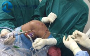 Tratamento Cirúrgico da Lesão do Ligamento Cruzado Posterior – LCP