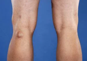 O cisto de Baker em atletas