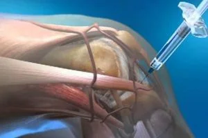 Exercícios para condromalacia: os 10 principais erros