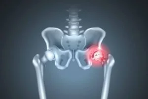 diferença entre artrite e artrose