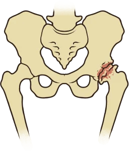 impacto femoroacetabular e lesão labral do quadril