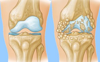 diferenca entre lesoes cartilagem artrose 1