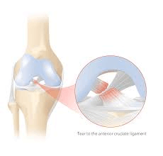 Rompimento do ligamento cruzado anterior (LCA)