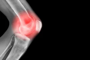 Tempo de recuperação da luxação patelar: como funciona o tratamento?