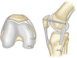 luxação recidivante da patela