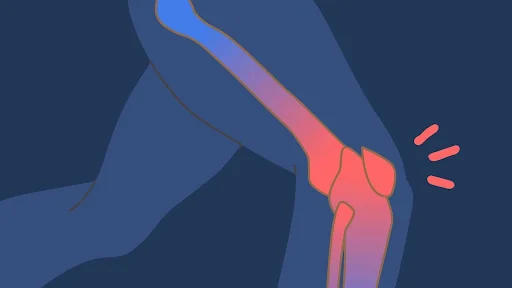 Mitos e verdades sobre lesoes da cartilagem do joelho