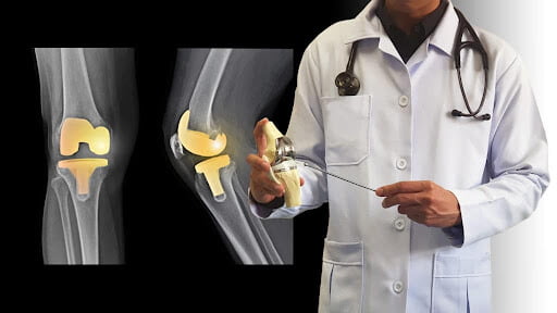 Como é a recuperação da cirurgia de prótese de joelho?