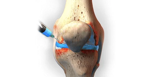 O que é uma infiltração no joelho?