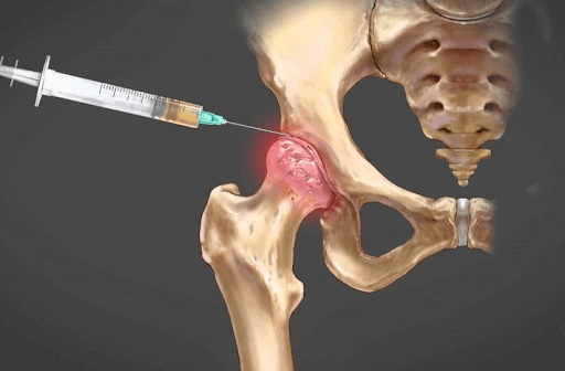 O que é uma infiltração para desgaste no quadril?