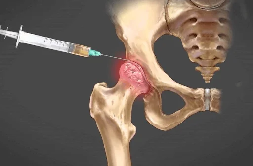 O que é uma infiltração para desgaste no quadril?