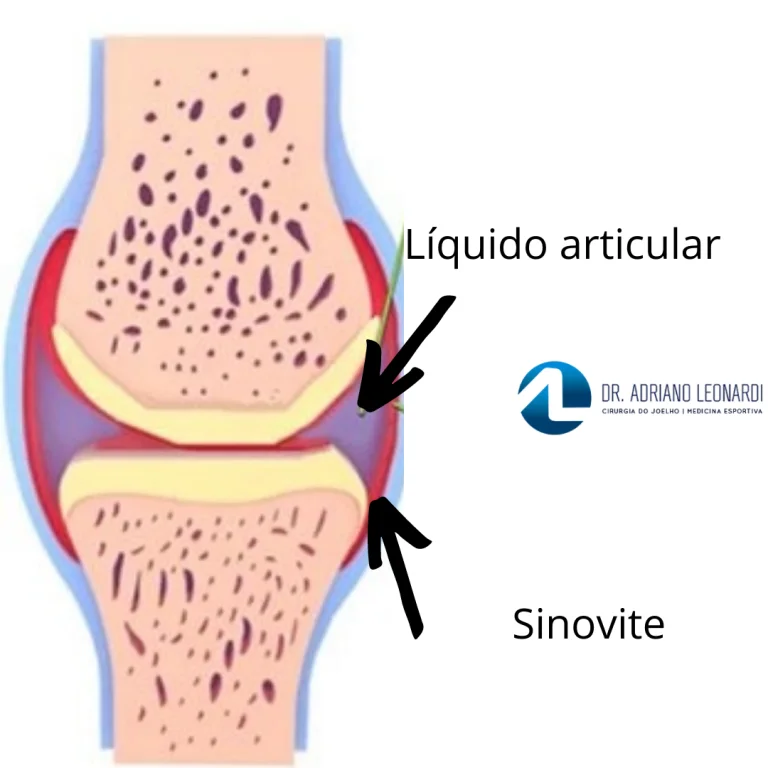 Derrame articular com sinais de sinovite