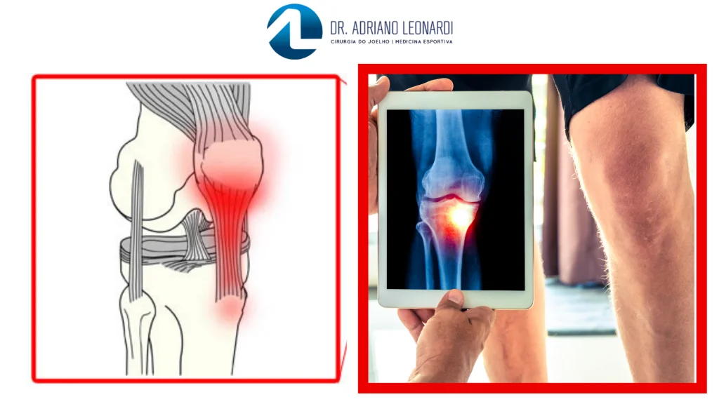 Tendinopatia no joelho 2