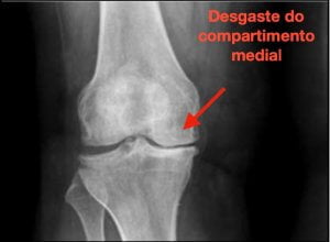 Desgaste do joelho- compartimento medial