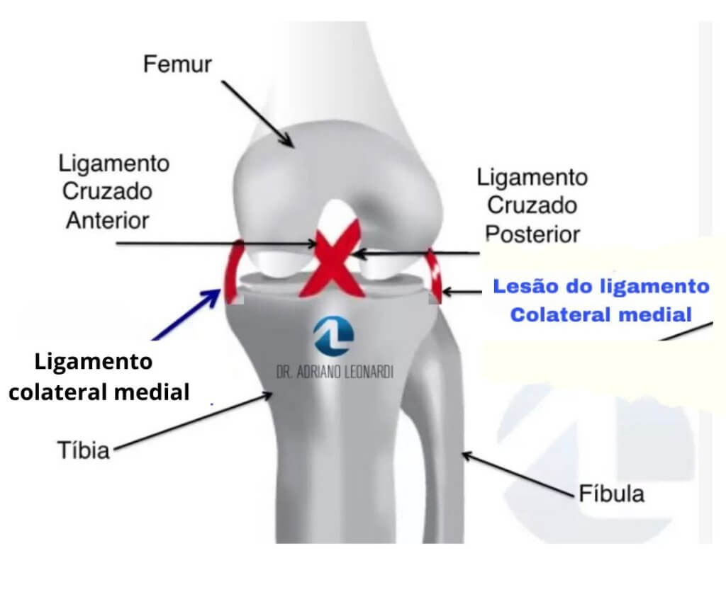 lesão de ligamento colateral lateral.