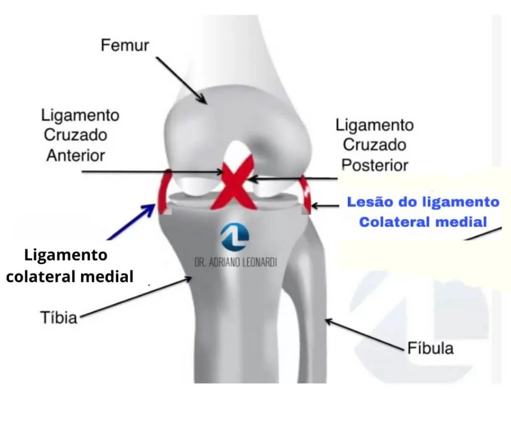 ligamento colateral lateral