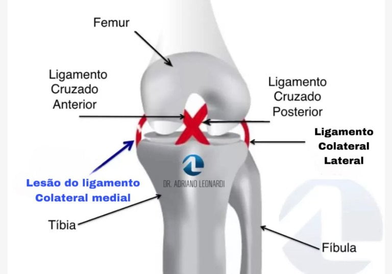 lesão do ligamento colateral medial