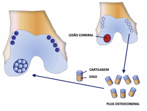 Condropatia Patelar Grau 4