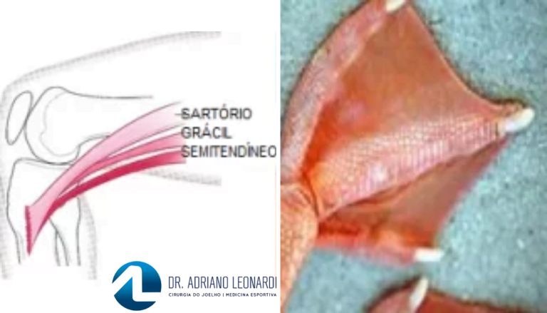 Tendinite Da Pata De Ganso Sintomas Diagnóstico E Tratamento 2504