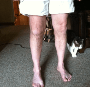 dor após cirurgia de prótese de joelho 2