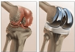 dor após cirurgia de prótese de joelho