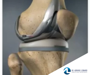 pós-operatório de cirurgia de prótese de joelho