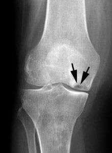 osteonecrose do joelho