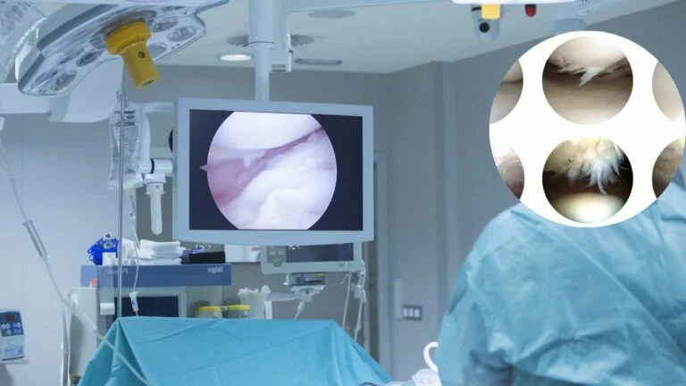 Condroplastia do joelho.