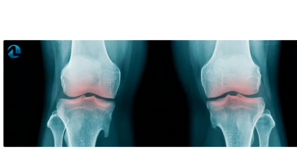 magnésio para artrose