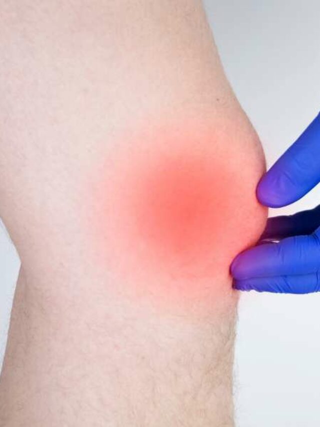 Edema ósseo no joelho.