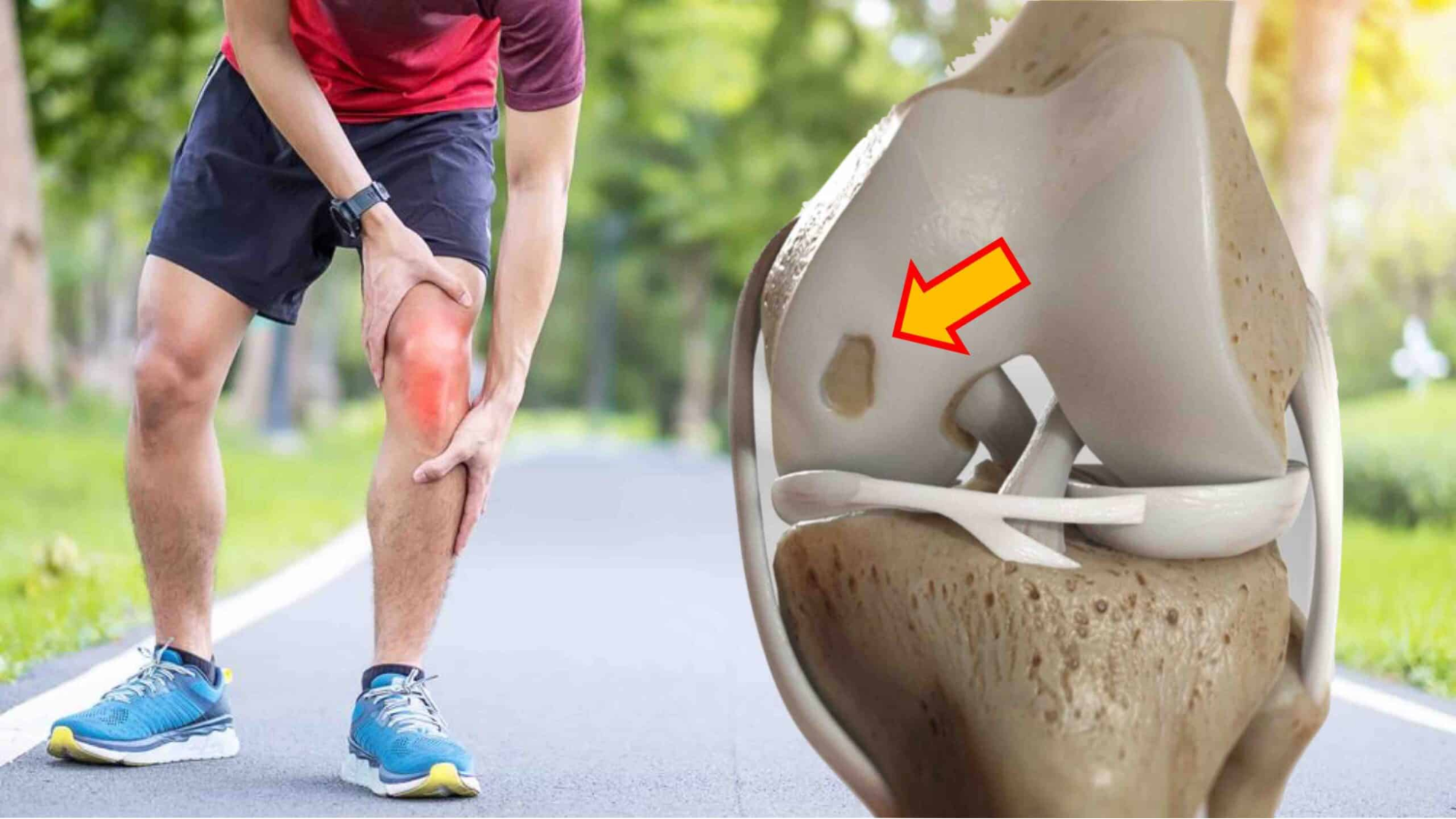Lesão cartilaginosa: tratamentos através da técnica de cirurgia de microfratura