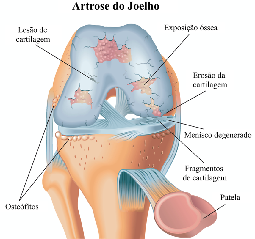 A CARTILAGEM ARTICULAR E OS PROBLEMAS DE CICATRIZAÇÃO
A cartilagem articular é um tecido que não possui irrigação sanguínea nem inervação. Ela é formada por quatro camadas e tem como função principal atuar como um colchão protetor entre os ossos, absorvendo impacto e distribuindo de forma homogênea a energia cinética nas articulações.
O grande desafio é que, quando há uma lesão, o potencial de cicatrização da cartilagem é muito baixo, praticamente nulo, exceto em alguns casos bem específicos.
Sempre que aparecem os chamados sinais cardinais da condropatia — como dor, inchaço (derrame articular, ou “água no joelho”), estalos ou atrofia muscular — e percebemos que a cartilagem não está cicatrizando, precisamos pensar em algum procedimento regenerativo. Entre eles, o mais estudado e consagrado pela literatura é justamente a técnica das microfraturas.
