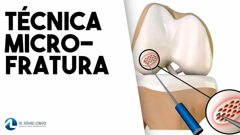 Lesão cartilagina, tratamento pela técnica de microfraturas.